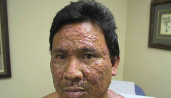 leprosy 3