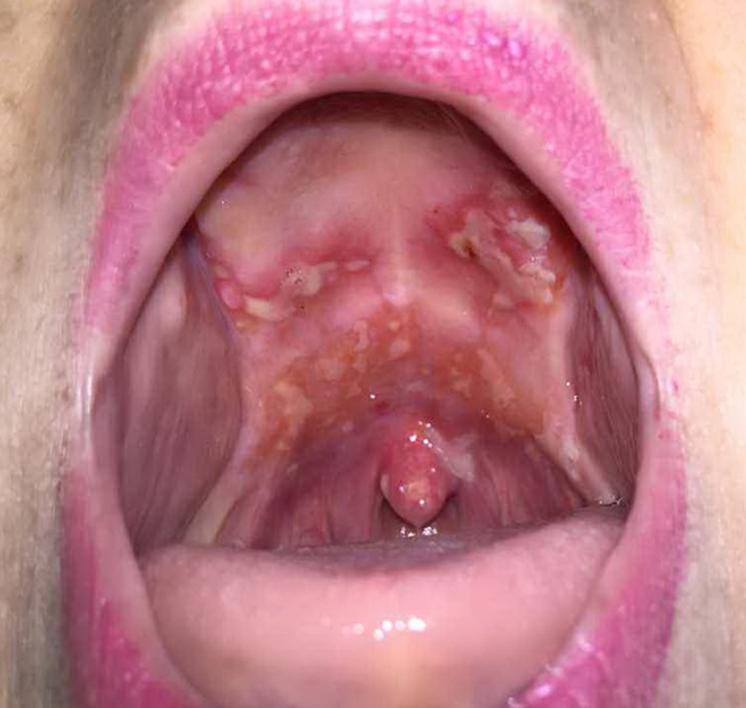 aphthous stomatitis tongue