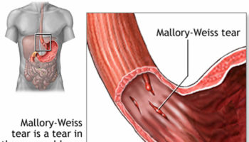 mallory weiss syndrome