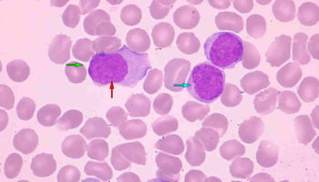 mantle cell lymphoma