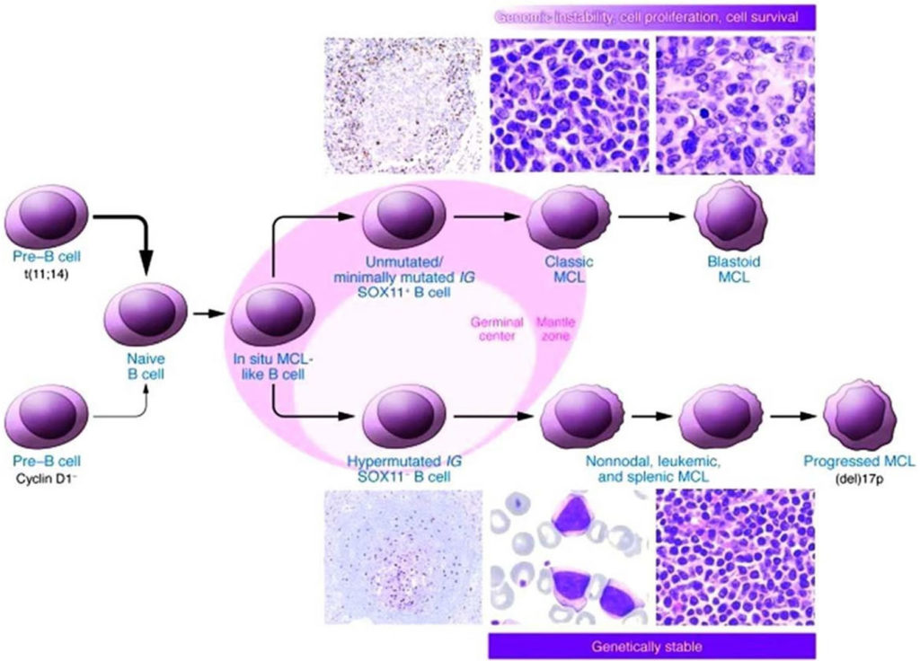 Mantle Cell Lymphoma Symptoms Diagnosis Prognosis And Treatment