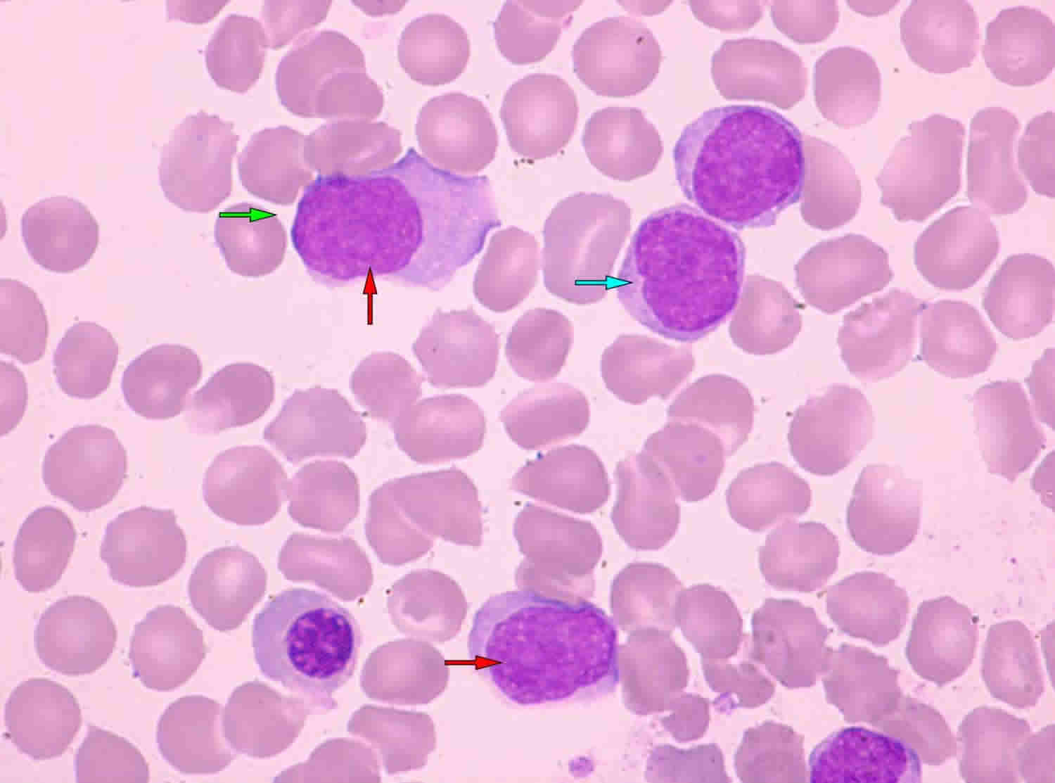 Mantle cell lymphoma prognosis