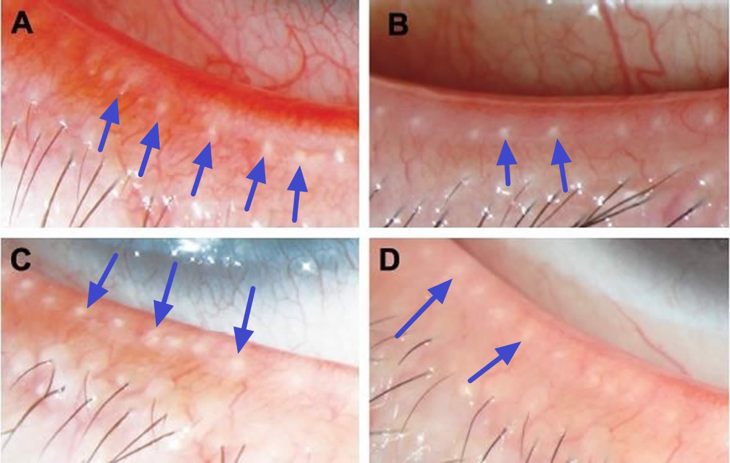 Meibomian gland openings on eyelids