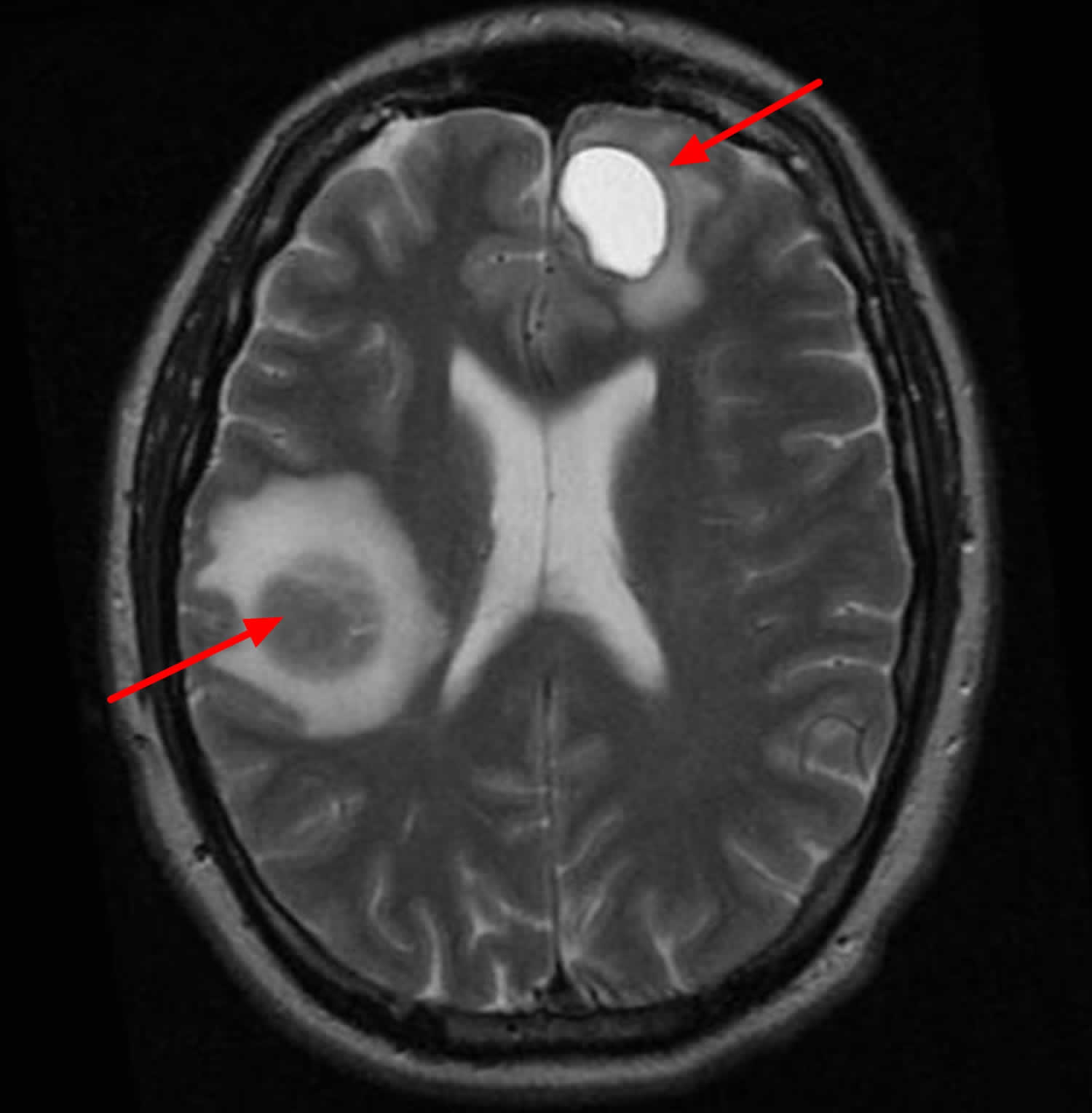 glioblastoma-and-brain-cancer-neuro-news-cosmo-clues