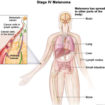 metastatic stage 4 melanoma