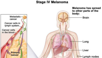 metastatic stage 4 melanoma