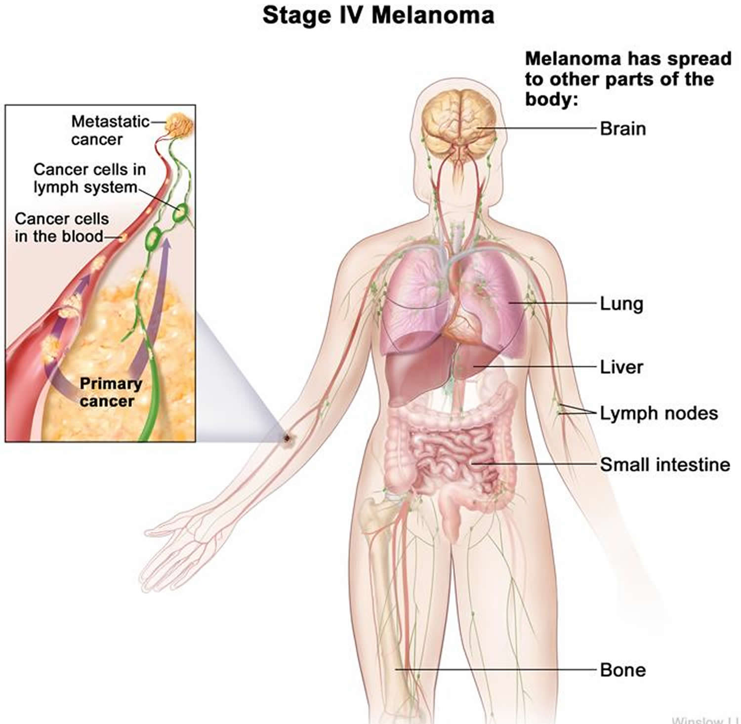 Metastatic stage 4 melanoma, life expectancy & metastatic ...