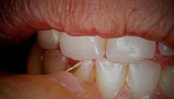 nail biting