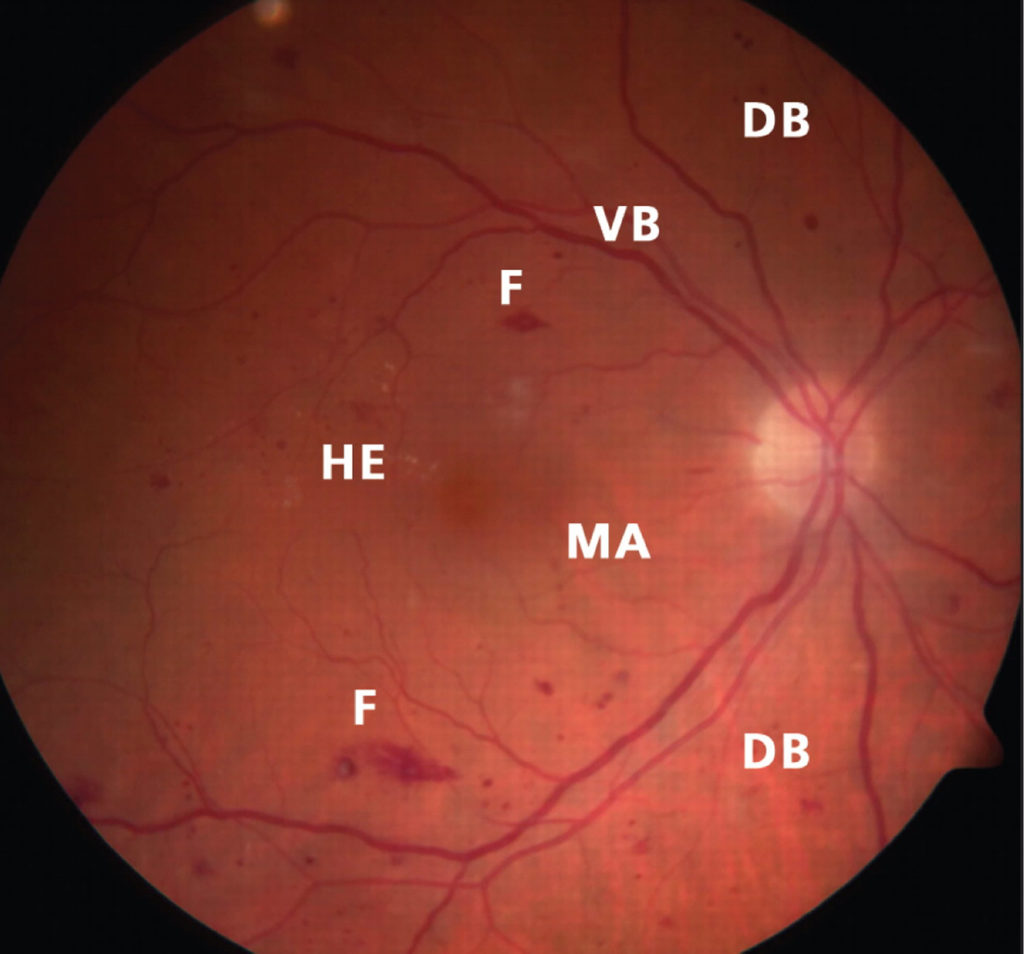 Diabetic retinopathy causes, symptoms, diagnosis, screening & treatment