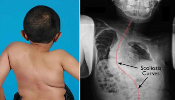 osteogenesis imperfecta
