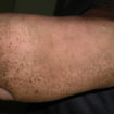 pitted keratolysis