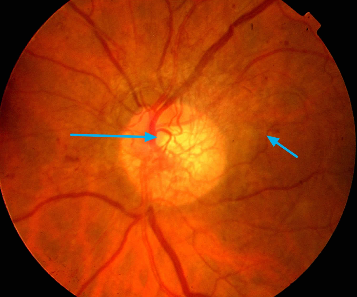 Состояние сетчатки. Диабетическая ретинопатия сетчатки. Непролиферативная ретинопатия. ETDRS диабетическая ретинопатия. Диабетическая ретинопатия глазное дно.