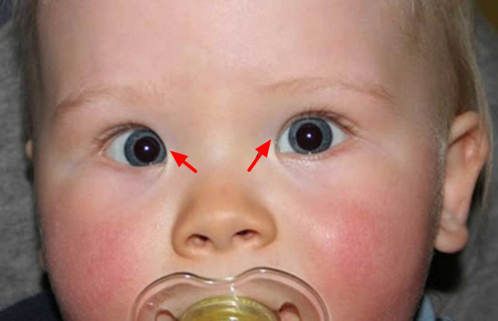 Strabismus causes, symptoms, diagnosis, strabismus treatment & surgery