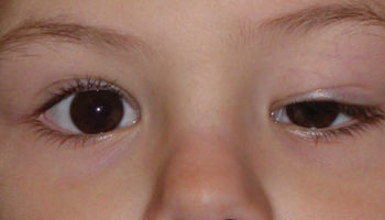 ptosis