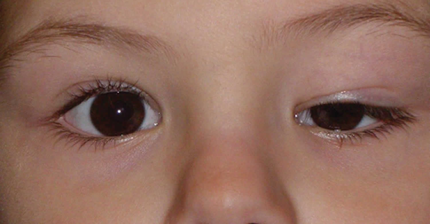 ptosis-droopy-eyelid-causes-droopy-eyelid-treatment-and-ptosis-surgery