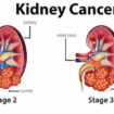 renal cell carcinoma