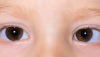 strabismus