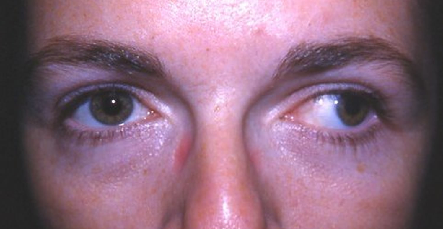 Strabismus Causes Symptoms Diagnosis Strabismus Treatment And Surgery