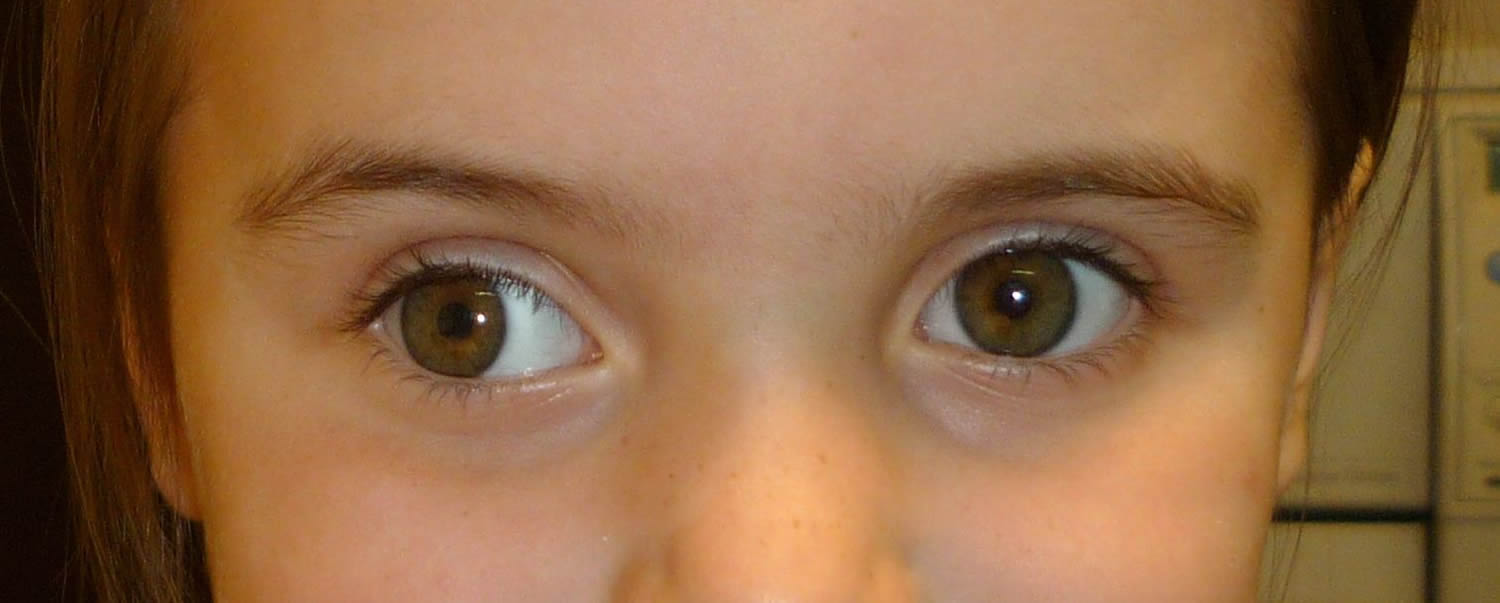 Strabismus causes, symptoms, diagnosis, strabismus treatment & surgery