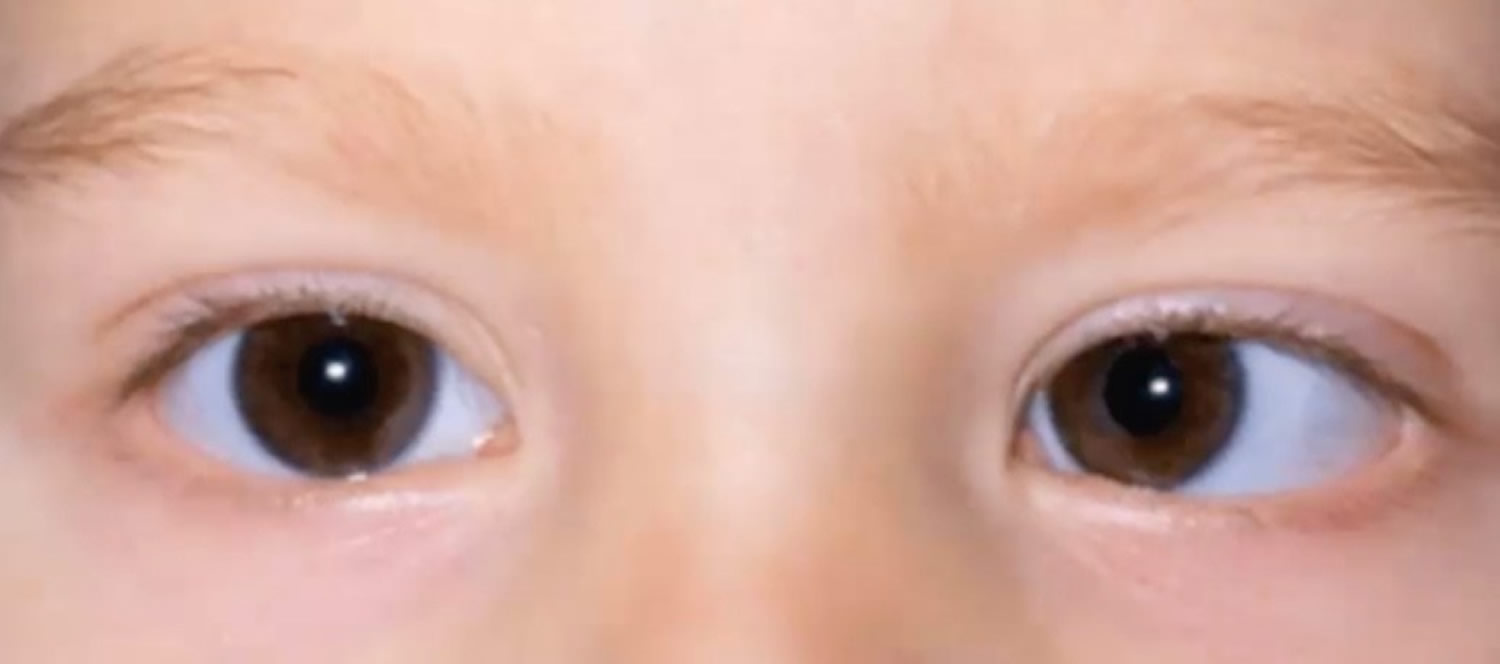 Strabismus Causes Symptoms Diagnosis Strabismus Treatment And Surgery 