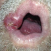 syphilis