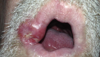 syphilis