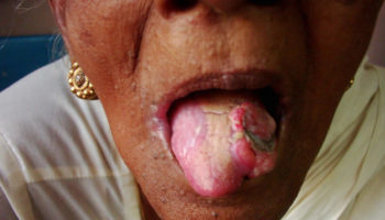tongue cancer