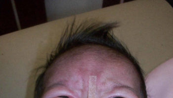 trisomy 13_Patau syndrome