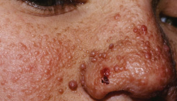 tuberous sclerosis