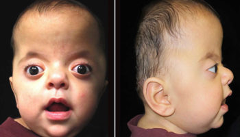 Apert syndrome