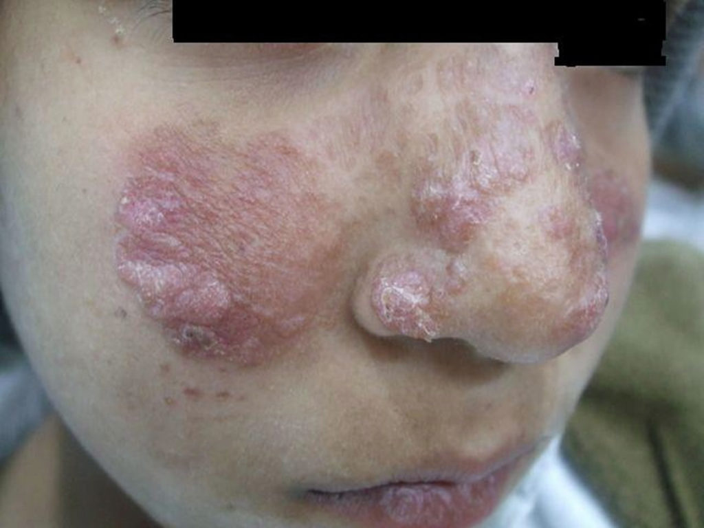 Cutaneous, visceral & mucocutaneous leishmaniasis symptoms & treatment