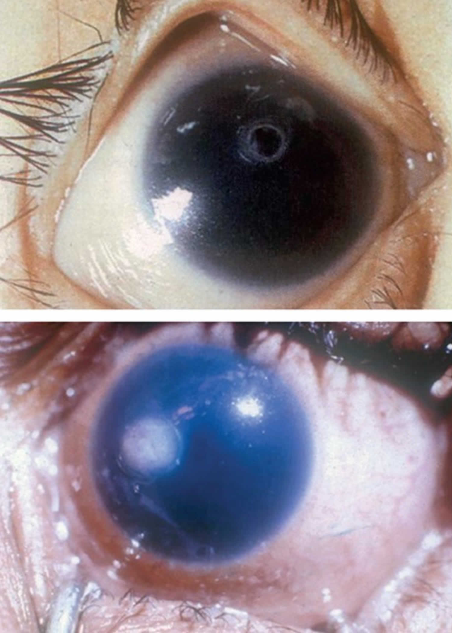 Corneal ulcer due to vitamin A deficiency