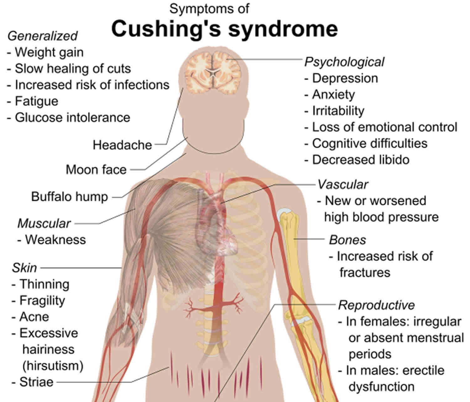 Cushing's Syndrome