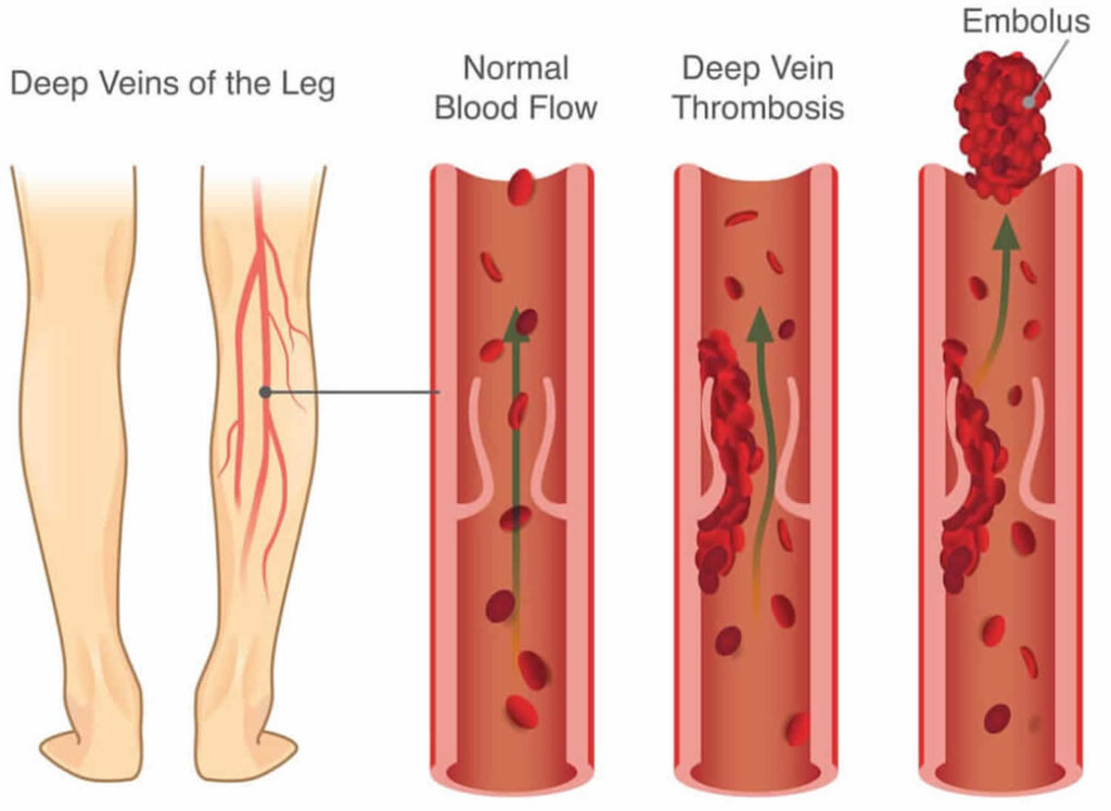 do blood clots travel down the leg