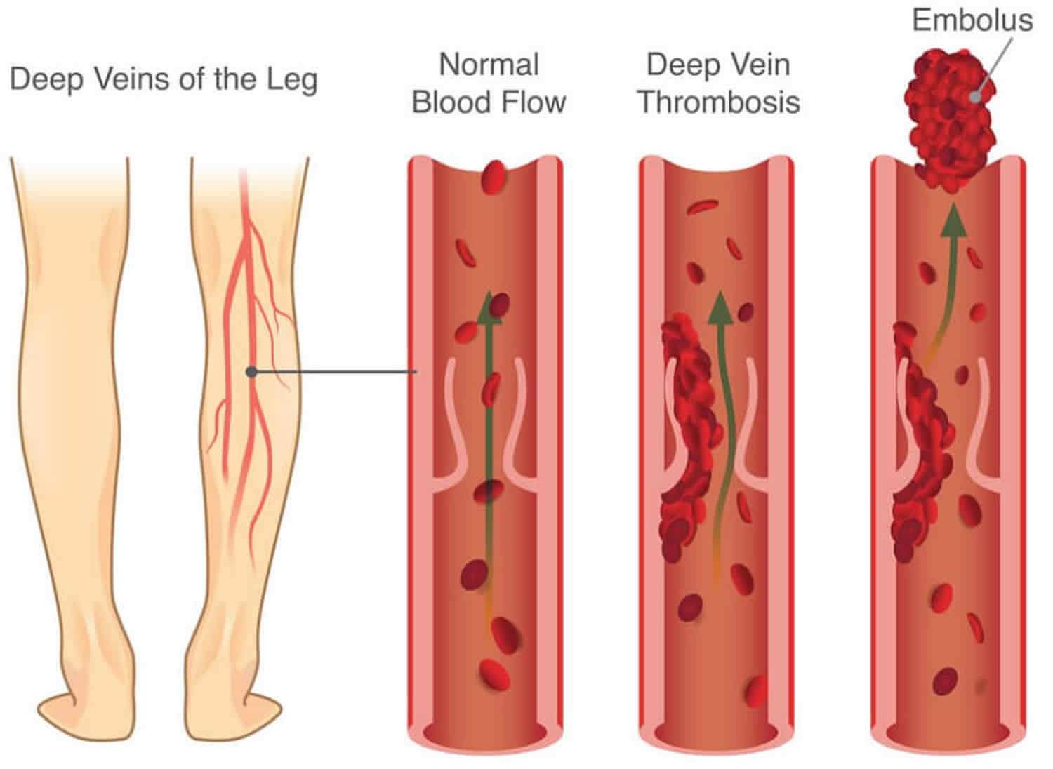 Blood Clot Causes Symptoms Diagnosis Prevention Prognosis Treatment