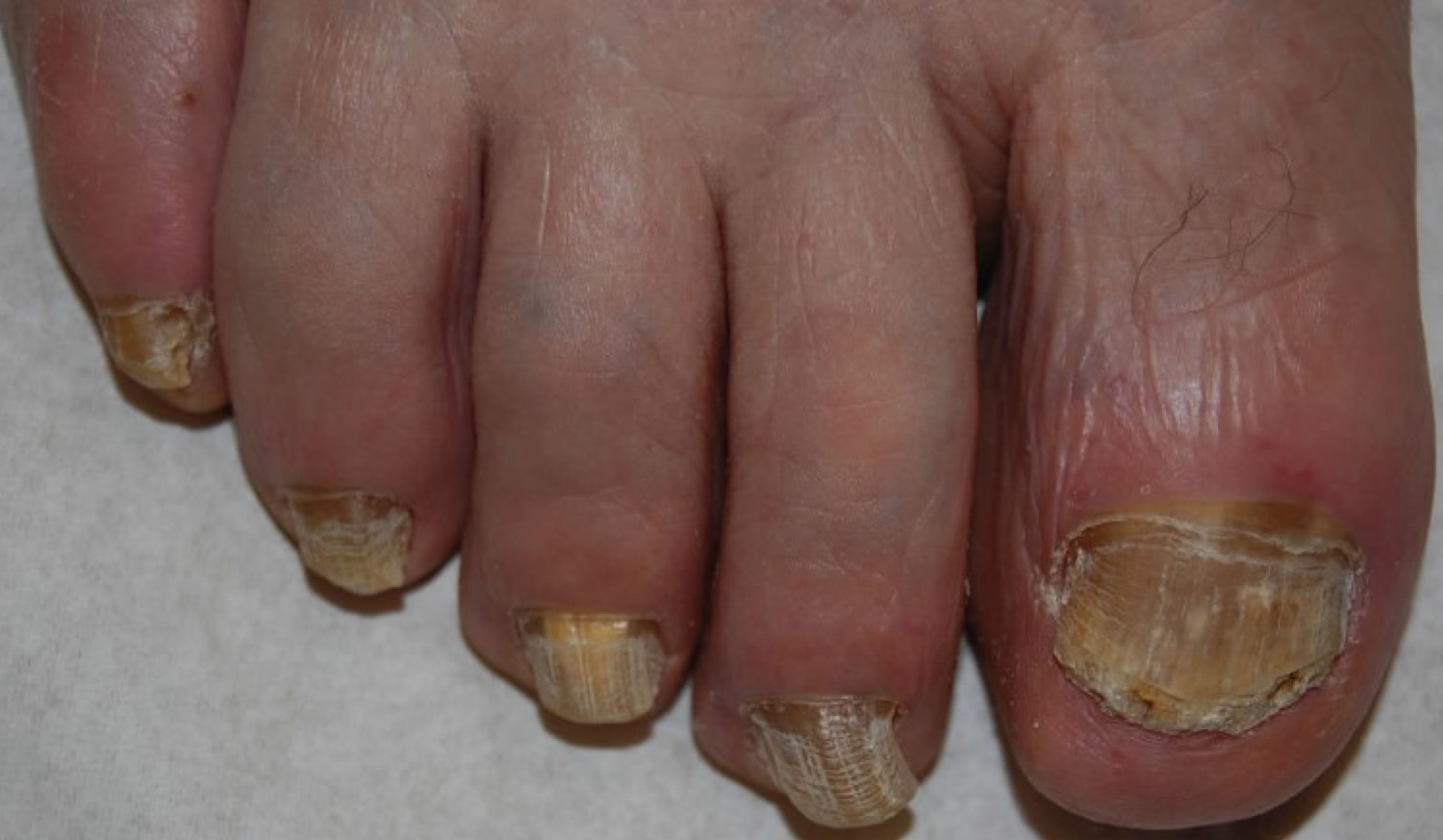 Onychomycosis causes, clinical appearance and onychomycosis treatment
