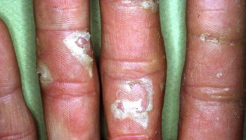 Exfoliative keratolysis