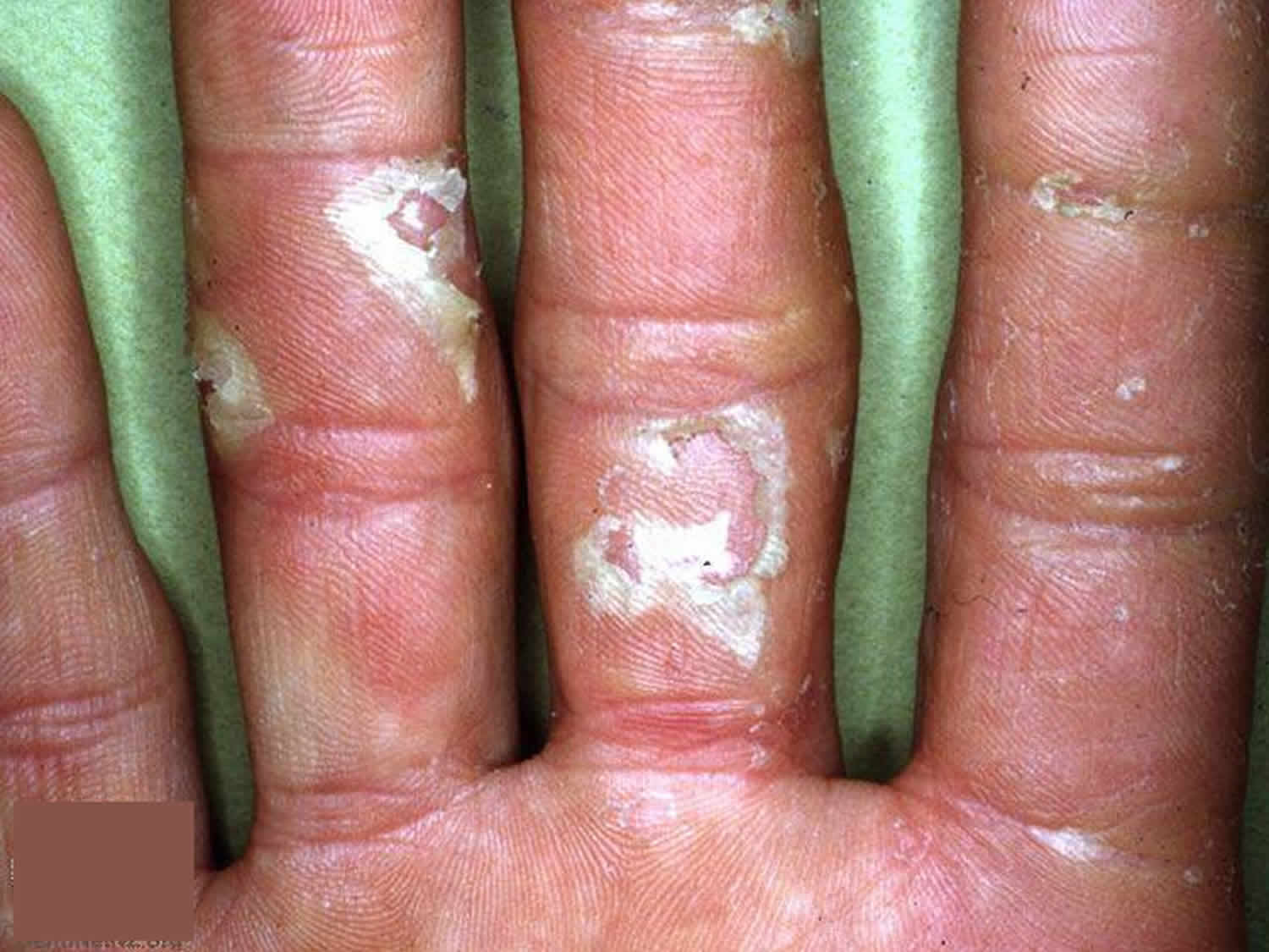 Peeling Skin On Hands And Feet Causes And Skin Peeling Treatment