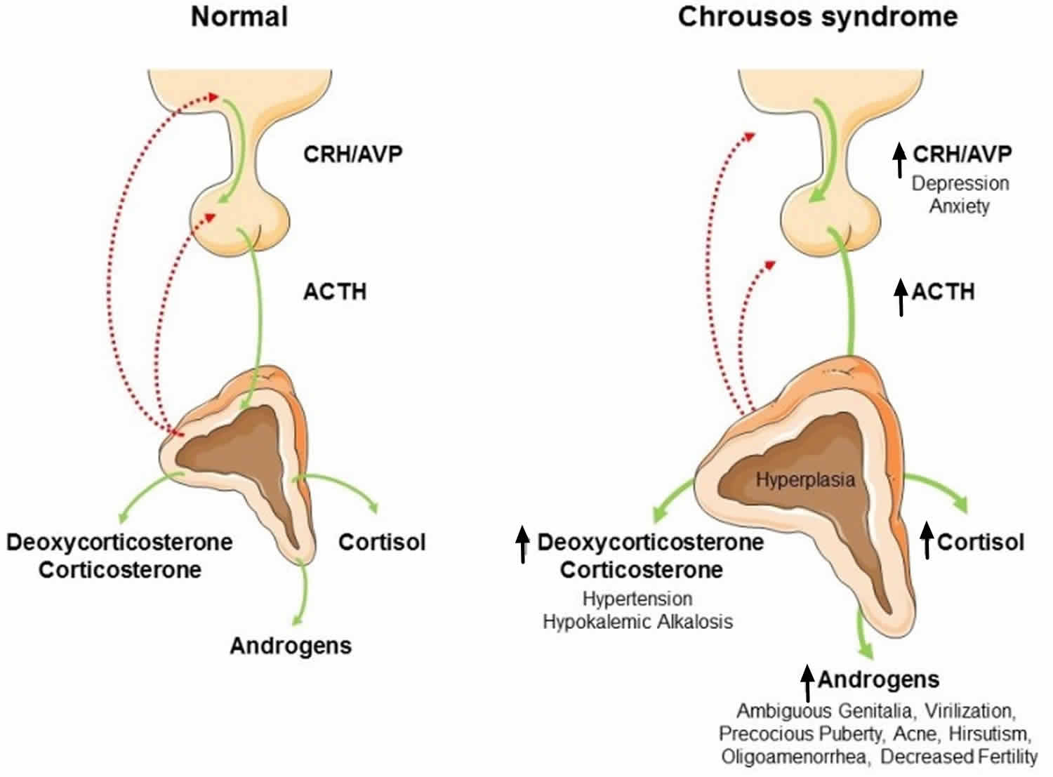 Glucocorticoid resistance syndrome