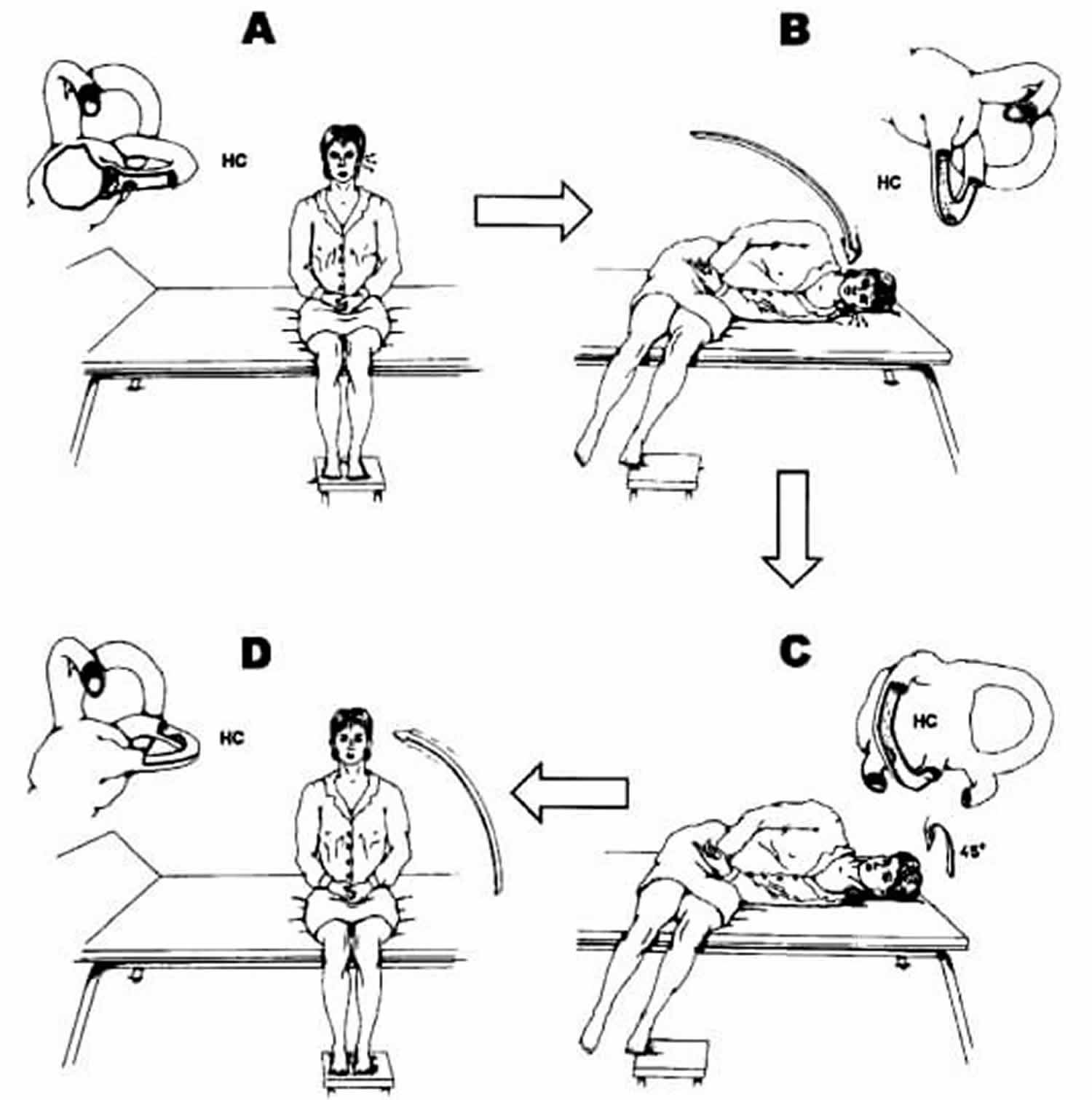 epley maneuver benign paroxysmal positional vertigo