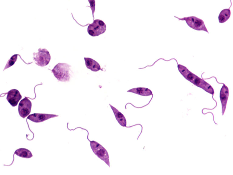 Cutaneous, visceral & mucocutaneous leishmaniasis symptoms & treatment