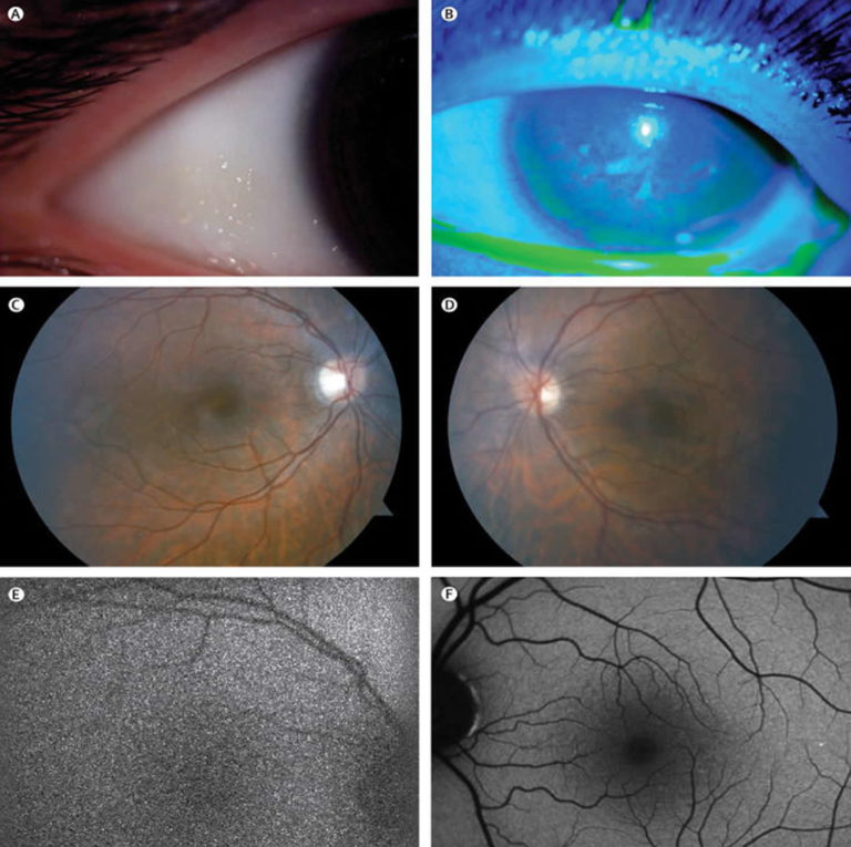 Vitamin A deficiency causes, signs, symptoms, prevention and treatment