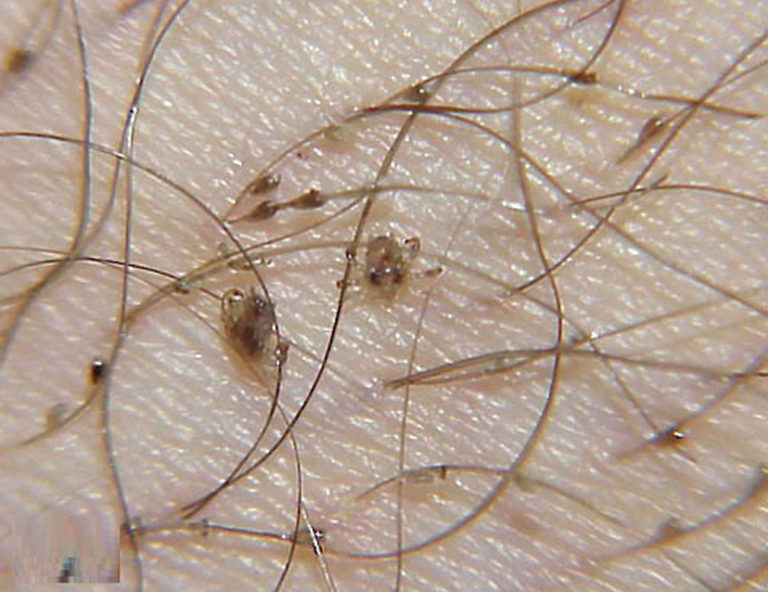 Pubic lice or crab lice signs, symptoms, transmission