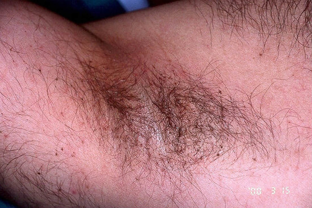 Pubic lice or crab lice signs, symptoms, transmission