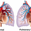 pulmonary arterial hypertension