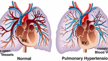 pulmonary arterial hypertension