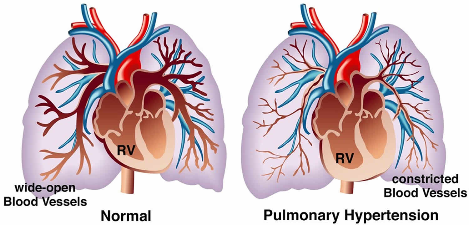 Pulmonary hypertension & pulmonary arterial hypertension causes