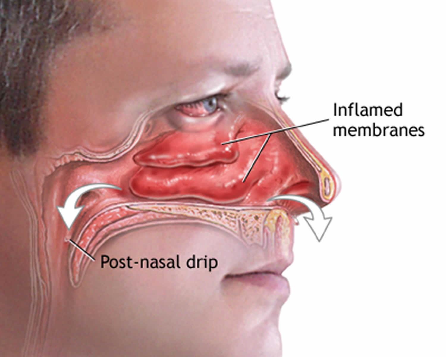 Another Word For Blocked Nose