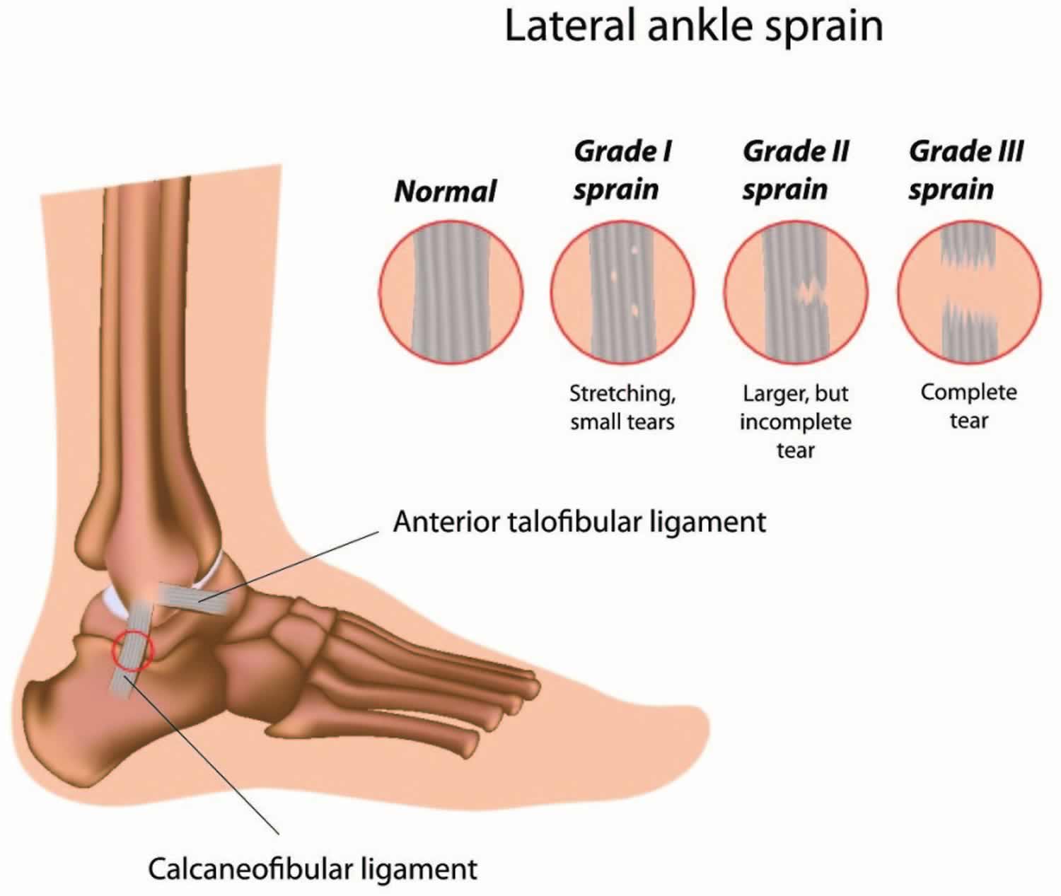 How To Relieve Torn Ligament In Foot