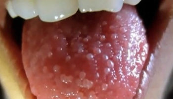 Transient lingual papillitis